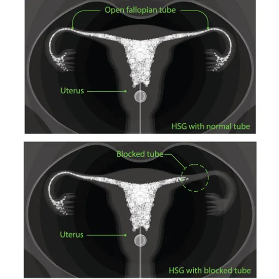 What are the types of HSG Test